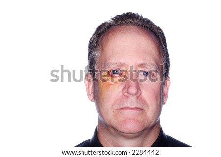 Man With Black Eye Stock Photos, Images, & Pictures | Shutterstock