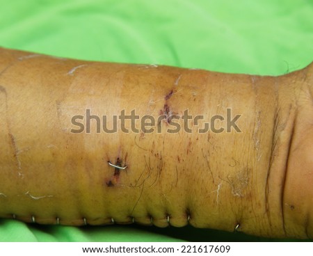 stock images similar to id 108133865 stitches on arm after stock images similar to id 108133865 stitches on arm after stock images similar to id 108133865 stitches on arm after stock images similar to id 108133865 stitches on arm after