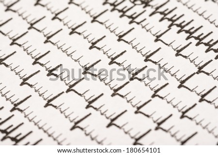 atrial fibrillation research paper atrial fibrillation research paper
