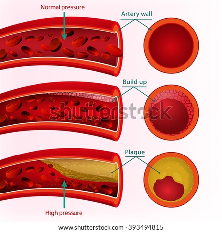 concept paper cerebral aneurysms An aneurysm is a weakening and bulging of an artery wall many have no symptoms and are not dangerous however, at their most severe, aneurysms can lead to life-threatening internal bleeding. concept paper cerebral aneurysms An aneurysm is a weakening and bulging of an artery wall many have no symptoms and are not dangerous however, at their most severe, aneurysms can lead to life-threatening internal bleeding.