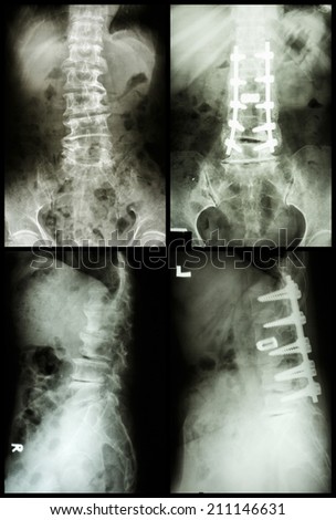Antero or retrolisthesis