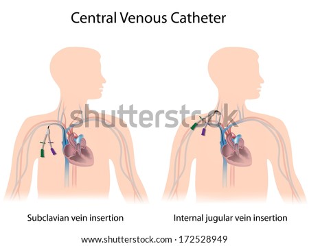 media central venous catheter blood collection media central venous catheter blood collection