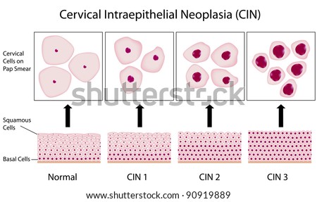 pap smear thesis Thesis directed by: that between 60 and 80 percent of us women have not had a pap smear performed in 2 the past five years, and some women. pap smear thesis Thesis directed by: that between 60 and 80 percent of us women have not had a pap smear performed in 2 the past five years, and some women.