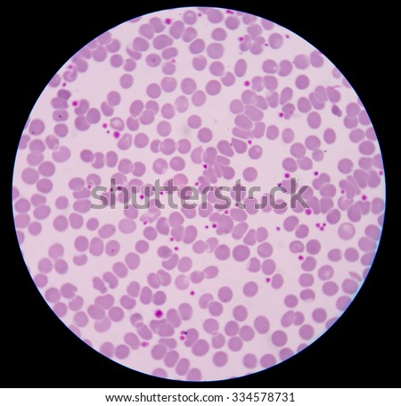 What are high blood platelets a sign of?