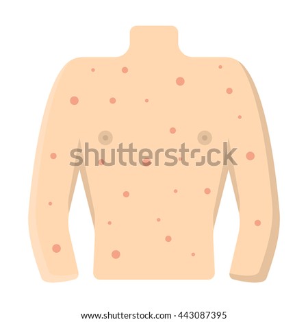 Scabies Stock Images, Royalty-Free Images & Vectors | Shutterstock