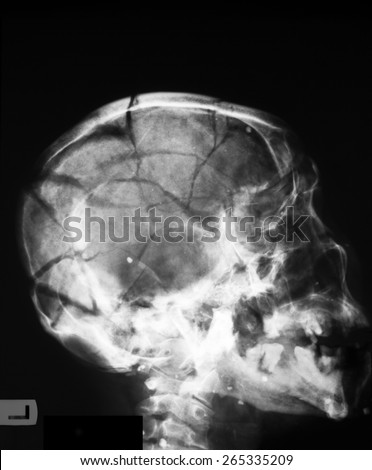 stock-photo-x-ray-image-of-broken-skull-