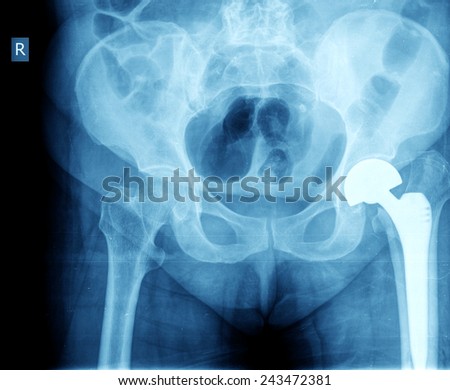 broken hip prothesis broken hip prothesis
