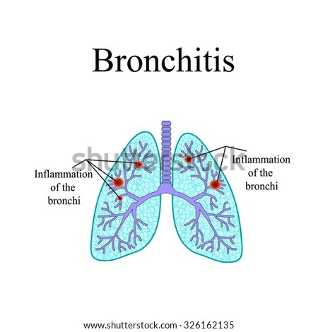 inhaler for bronchitis while pregnant