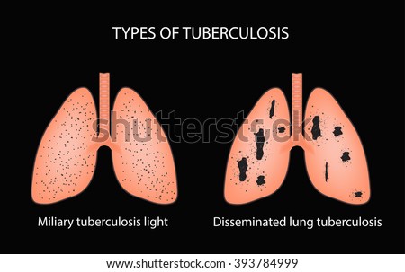 the background of common infection pulmonary tuberculosis Nontuberculous mycobacteria (ntm) are all the other mycobacteria which can cause pulmonary disease resembling tuberculosis, lymphadenitis, skin disease, or disseminated disease although over 150 different species of ntm have been described, pulmonary infections are most commonly due to mycobacterium avium complex (mac), mycobacterium kansasii. the background of common infection pulmonary tuberculosis Nontuberculous mycobacteria (ntm) are all the other mycobacteria which can cause pulmonary disease resembling tuberculosis, lymphadenitis, skin disease, or disseminated disease although over 150 different species of ntm have been described, pulmonary infections are most commonly due to mycobacterium avium complex (mac), mycobacterium kansasii.