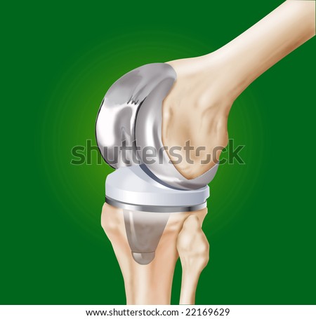 orthopedic prothesis orthopedic prothesis
