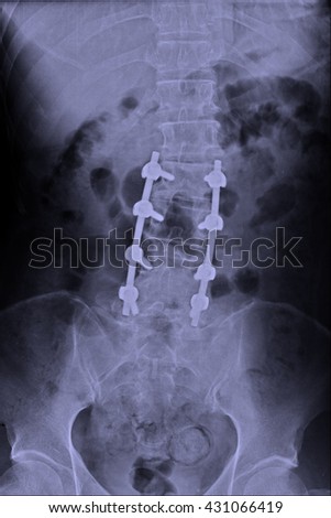 icd 10 post lumbar surgery