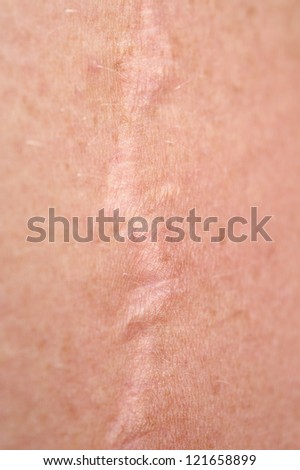 macro scar on the human skin stock photo image 61059545 scars stock photos images pictures macro scar on the human skin stock photo image 61059545 scars stock photos images pictures
