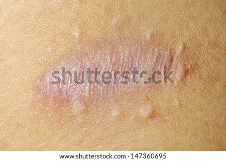 scar on human skin stock photo 121658896 quot skin scar quot stock photos royalty free images vectors scar on human skin stock photo 121658896 quot skin scar quot stock photos royalty free images vectors