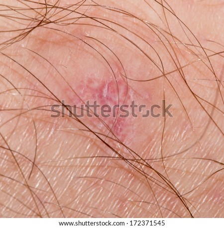 stock images similar to id 108133865 stitches on arm after stock images similar to id 108133865 stitches on arm after stock images similar to id 108133865 stitches on arm after stock images similar to id 108133865 stitches on arm after