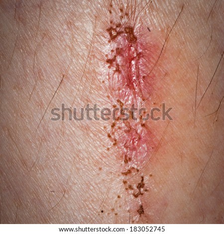 Scab Stock Photos, Images, & Pictures 