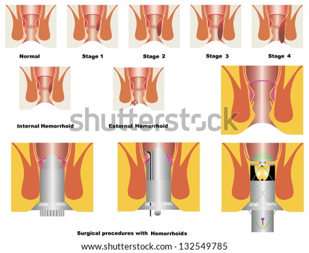 Hemorroide Externe Non Douloureuse – Hemoroide Interne Hemorroide Externe Non Douloureuse – Hemoroide Interne