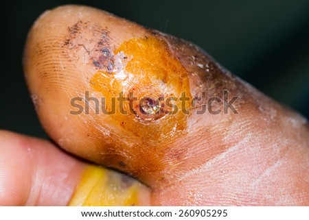 stock images similar to id 108133865 stitches on arm after stock images similar to id 108133865 stitches on arm after stock images similar to id 108133865 stitches on arm after stock images similar to id 108133865 stitches on arm after