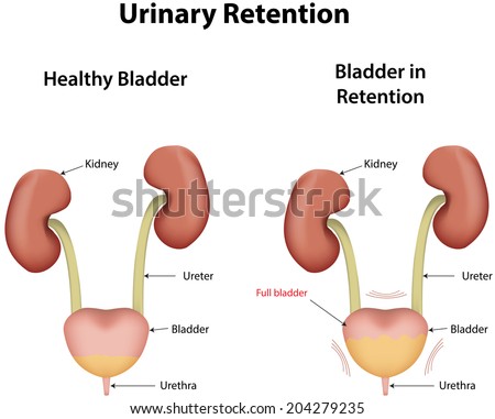 urinary retention diagram labeled shutterstock micturition gilead generic license update version illustration kidney