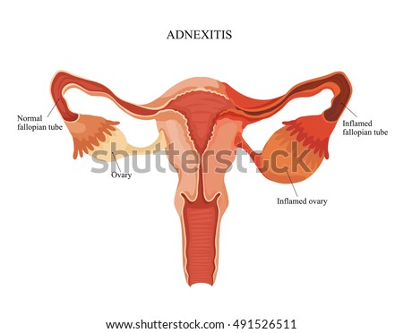 How to treat inflammation of ovaries? - Top Wellness Life