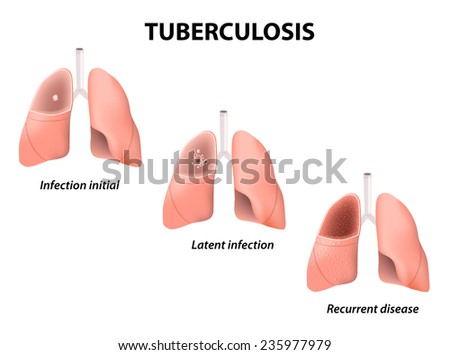 Tuberculosis The Teen Was 7