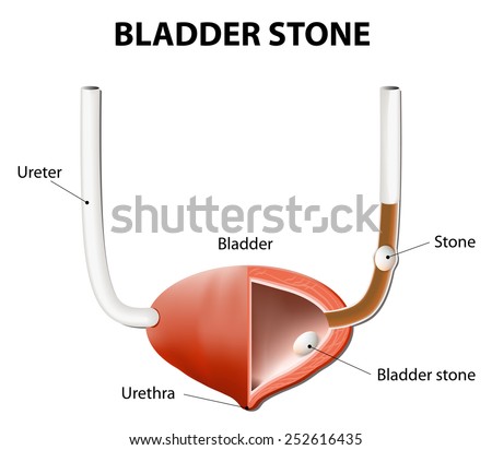Stones in the urinary bladder and ureter. human anatomy. illustration