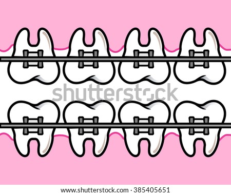 Braces Teeth Stock Photos, Images, & Pictures | Shutterstock