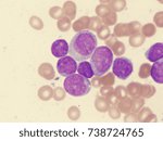 Small photo of Acute myelogenous leukemia (AML), M4 subtype