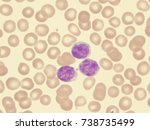 Small photo of Chronic lymphocytic leukemia (CLL), B-cell subtype