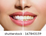 stock-photo-woman-teeth-before-and-after-whitening-over-white-background-happy-smiling-woman-dental-health-167843159.jpg