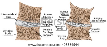 endplate lumbar fourth coronal third section through sclerosis vertebral shutterstock vertebrae involving spinal illustration intervertebral disk narrowing segment motion space