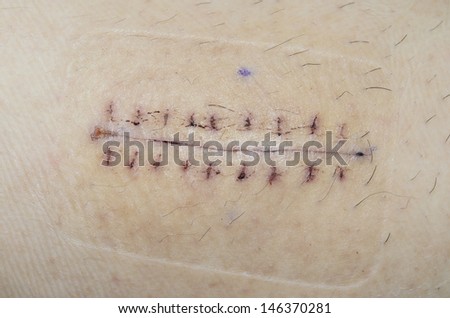 Stitches Skin Stock Images, Royalty-Free Images & Vectors | Shutterstock