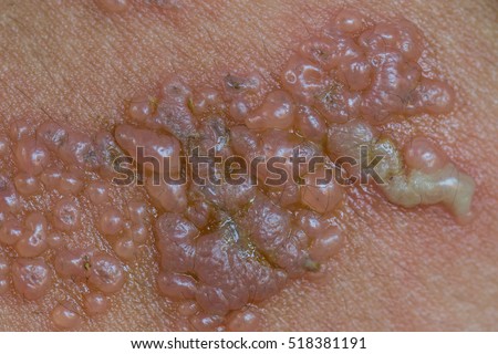 Herpes-simplex- Stock Images, Royalty-Free Images & Vectors | Shutterstock