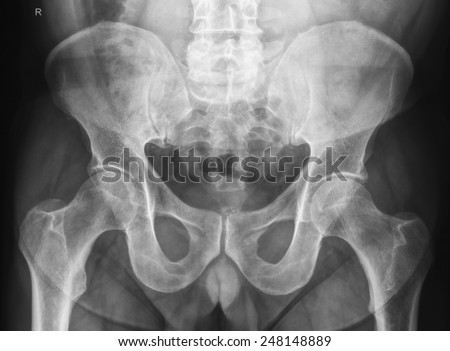Xray Picture Showing Male Pelvis Artificial Stock Photo 22787125 ...
