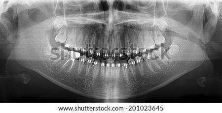 Stock Images similar to ID 93728623 - panoramic dental x ray with...