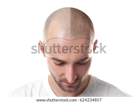 hair loss treatment for men