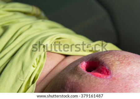 steroid injection abscess