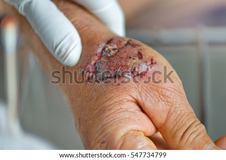 Dog bit infections