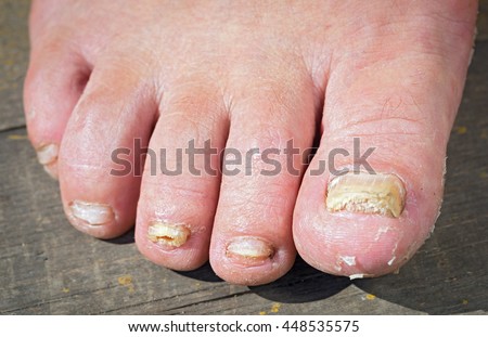 Nhiễm nấm trên Móng tay của chân Man