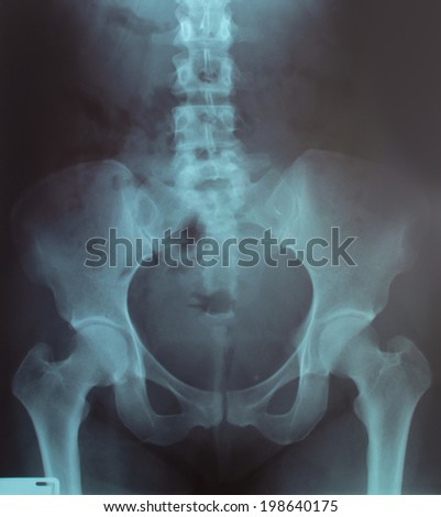 Xray Picture Showing Female Pelvis Stock Photo 36117439 - Shutterstock