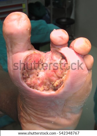 Diabetic Foot Pain Ulcers Skin Sores Stock Photo 542348767 - Shutterstock