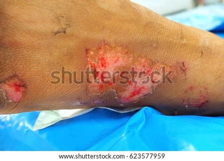 Facial infection treatment wound Multiple orgasms oversexed