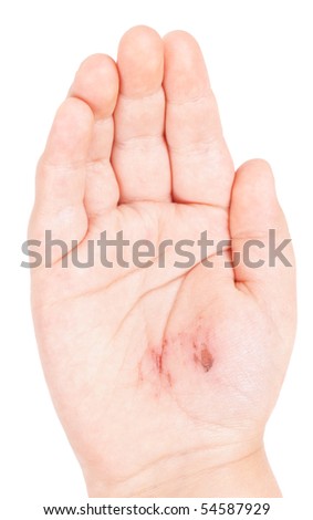 Infection Or Abrasion Of The Skin Stock Photos, Images, & Pictures ...