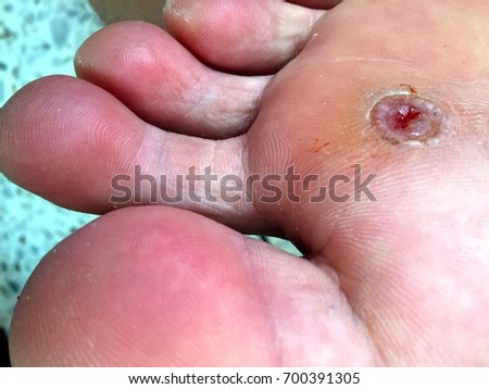 Foot Ulcer Stock Images, Royalty-Free Images & Vectors | Shutterstock