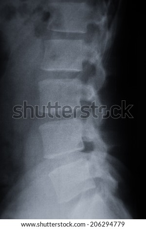 L5 S1 Lumbar Spot Xray Stock Photo 3679996 - Shutterstock