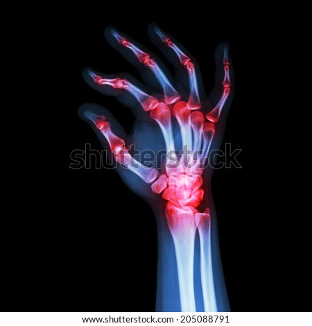 Arthritis Hands Stock Photos, Images, & Pictures | Shutterstock