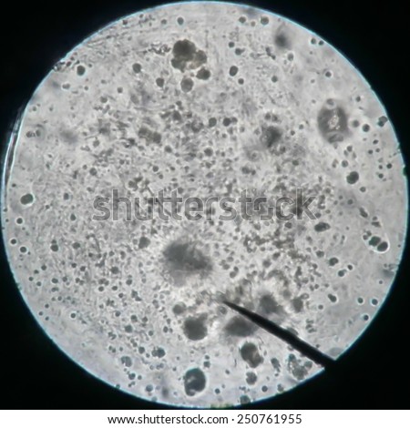 Cytology smear of pleural effusion showing candida (fungi) organism ...