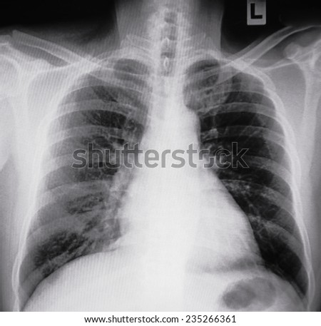 Human Chest Xray Elderly Person Stock Photo 49533298 - Shutterstock