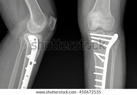 Femur Stock Photos, Images, & Pictures | Shutterstock