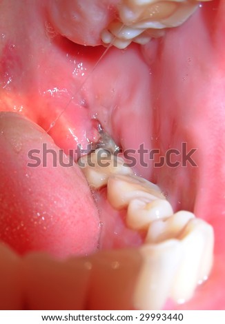 tooth blood extraction wisdom clot shutterstock