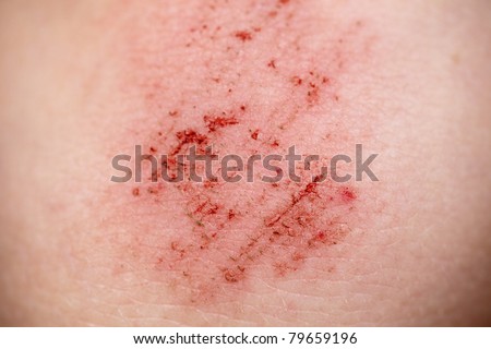 Skin injury Stock Photos, Images, & Pictures | Shutterstock